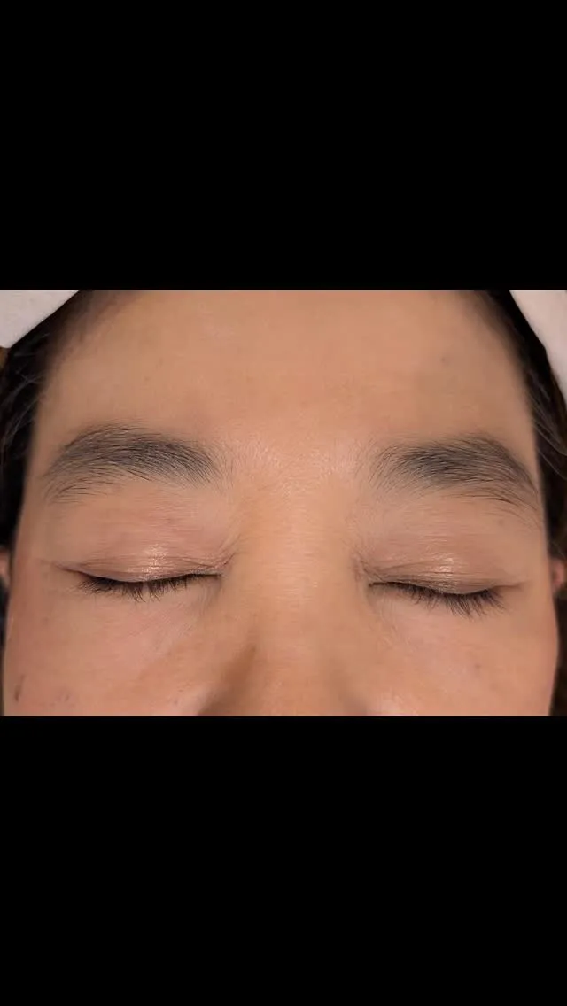 アイブロウリフト